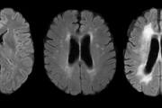 Imatge d'una ressonància del cervell.