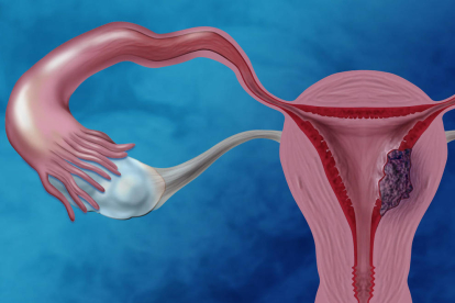 El càncer d'endometri és un dels més comuns.