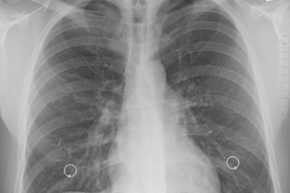 Radiografia dels pulmons.