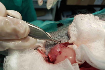 Les agulles extretes durant l'operaicó.