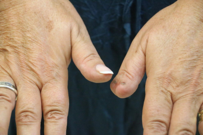Pla detall de les mans de la víctima, amb les seqüeles de la mossegada en un dit polze. Imatge del 27 de setembre de 2016