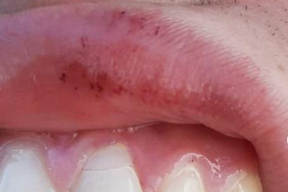 Imagen de la «fractura horizontal del primer incisivo superior izquierda» y la herida en el labio que denuncia a Iker Torre.