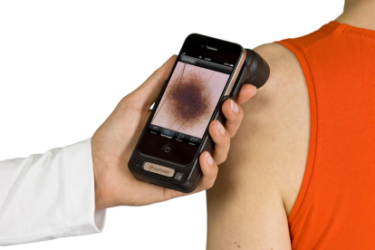 Los médicos usarán móviles que incorporan un dermatoscopio.