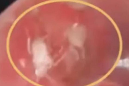 Imagen de algunas de las cucarachas que encontraron dentro de la oreja del paciente