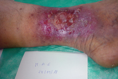 Imagen de una herida crónica en el pie