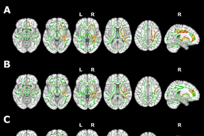 Imagen de resonancia magnética para comprobar el efecto del insomnio en la sustancia blanca cerebral.