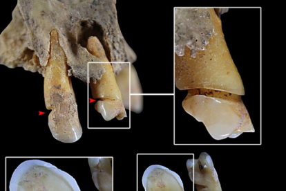 Dentición del individuo 90 de Castellón Alto con evidencias de uso paramasticatorio de la dentición.