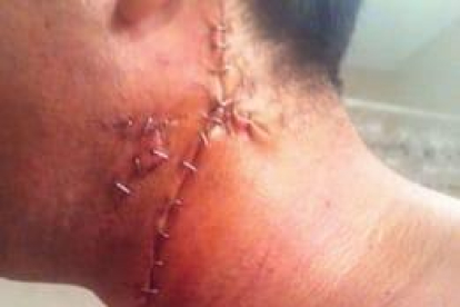 Imatge de la ferida de la víctima, amb una sutura de 17 punts.