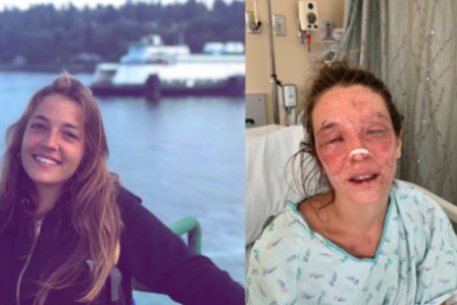 Marta Bustos, de 24 anys, va patir un greu accident que li ha afectat a la cara i ulls