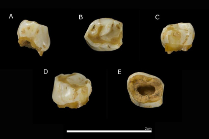 Diverses vistes de la dent de llet que ha servit per a datar els neandertals.