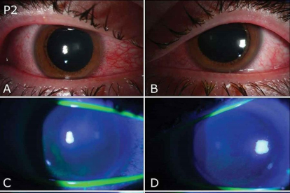 Imagen de los ojos de un paciente que sufre fotoqueratitis a causa de la exposición a una luz germicida.