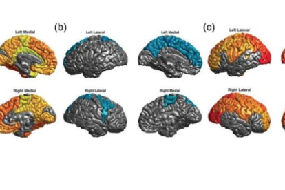 Imagen obtenida por Resonancia Magnética del cerebro de pacientes con trastorno bipolar.