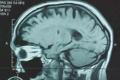 Resonancia magnética de un cerebro en el que se aprecia un tumor. / EFE