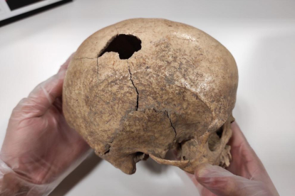 Imagen del cráneo que ha sido estudiado y se ha determinado la causa de la muerte del individuo.