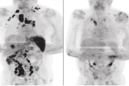 Comparación entre la tomografía computerizada del paciente antes del covid 19 (izquierda) y después (derecha).
