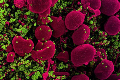 Micrografía de una célula apoptótica infectada con partículas del virus SARS-COV-2.