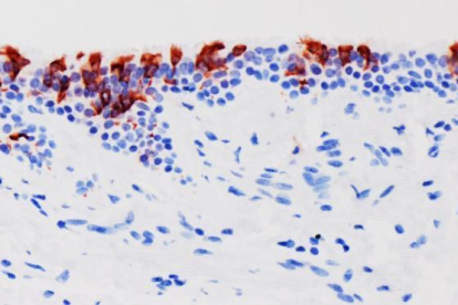 La variante ómicron del SARS-CoV-2 (en rojo) infectando tejidos de bronquios humanos.