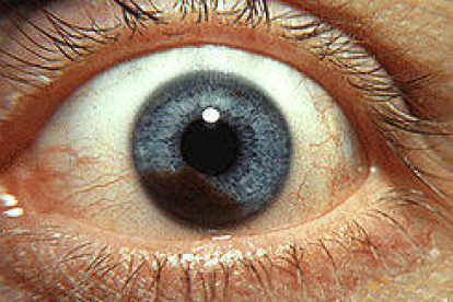 Imagen de un melanoma en el iris de un ojo.