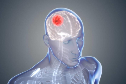 El fàrmac s'ha demostrat eficaç contra el tumor cerebral més comú, el glioblastoma.