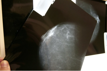 Imagen de una mamografía.