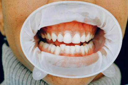 La malaltia periodontal afecta a les genives i la mandíbula.