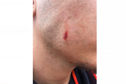 Imatge de la ferida d'un aficionat del Nàstic, provocada per una pedrada
