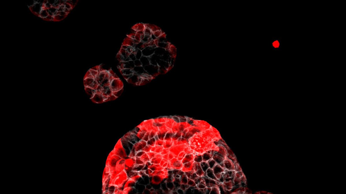 Organoide de càncer colorectal amb cèl·lules residuals responsables de la recaiguda marcades en vermell.