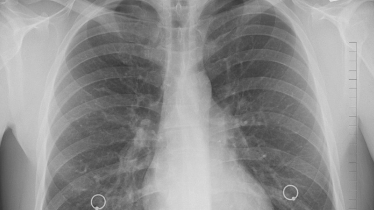 Radiografia dels pulmons.