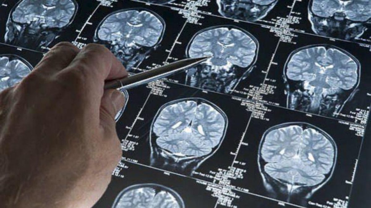 Imagen de una resonancia de un paciente con Alzheimer