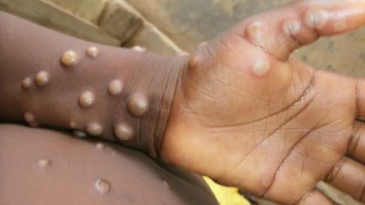 Imatge d'un nen afectat pel virus de la verola del mico.