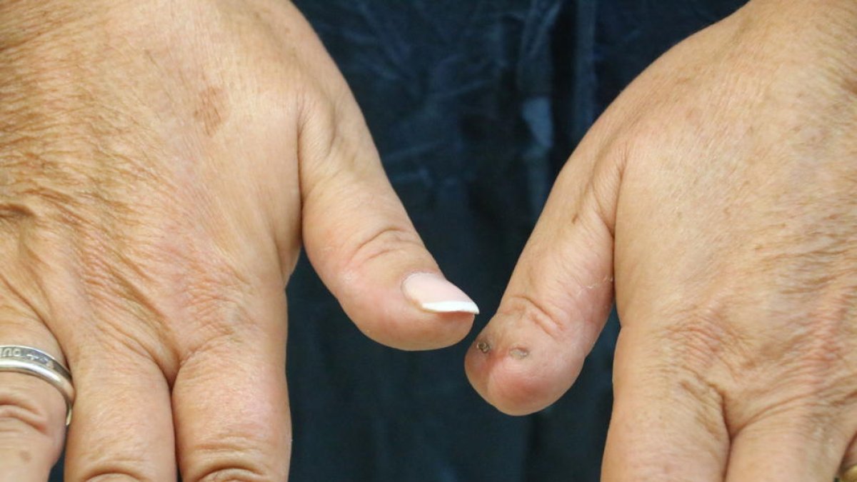 Pla detall de les mans de la víctima, amb les seqüeles de la mossegada en un dit polze. Imatge del 27 de setembre de 2016