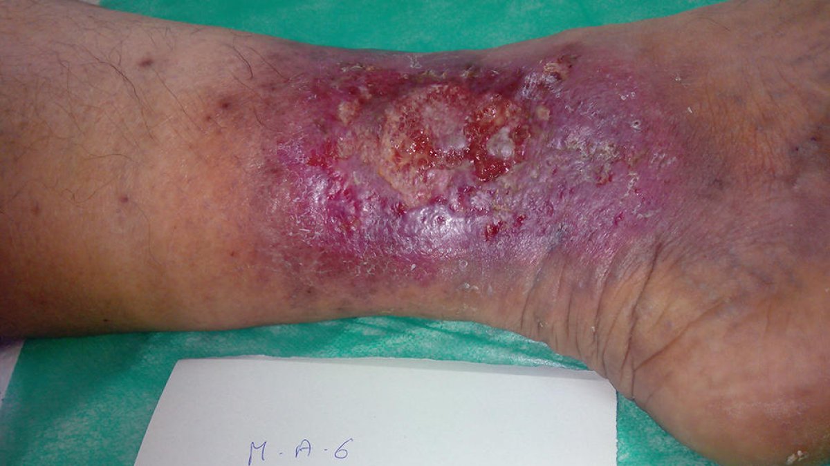 Imatge d'una ferida crònica al peu
