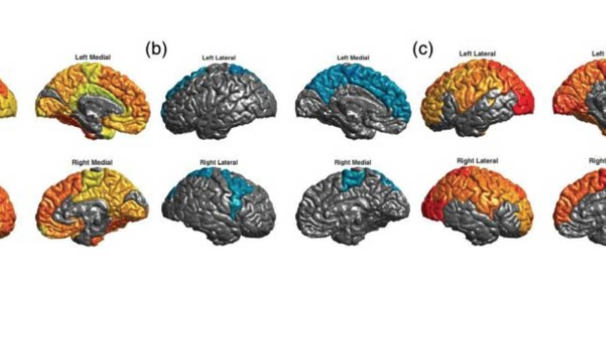 Imagen obtenida por Resonancia Magnética del cerebro de pacientes con trastorno bipolar.