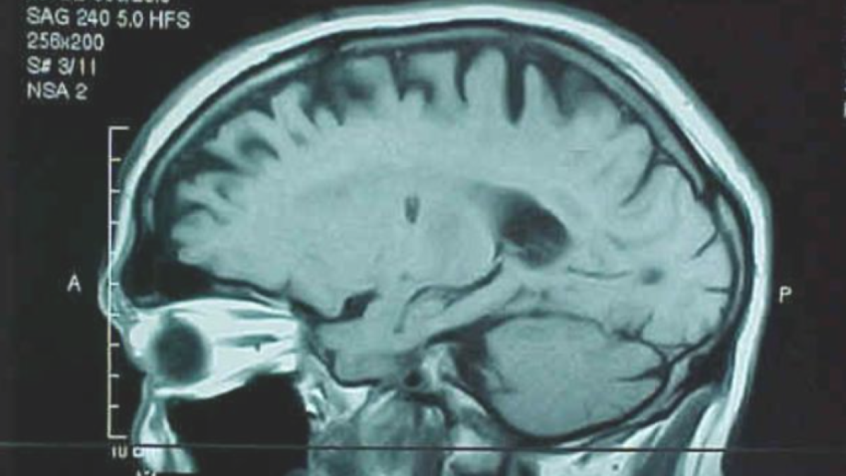 Resonancia magnética de un cerebro en el que se aprecia un tumor. / EFE