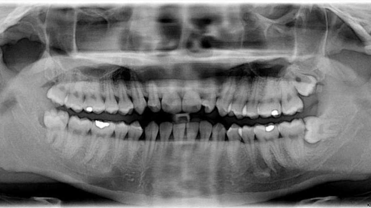 Radiografia on es veuen els queixals del judici.