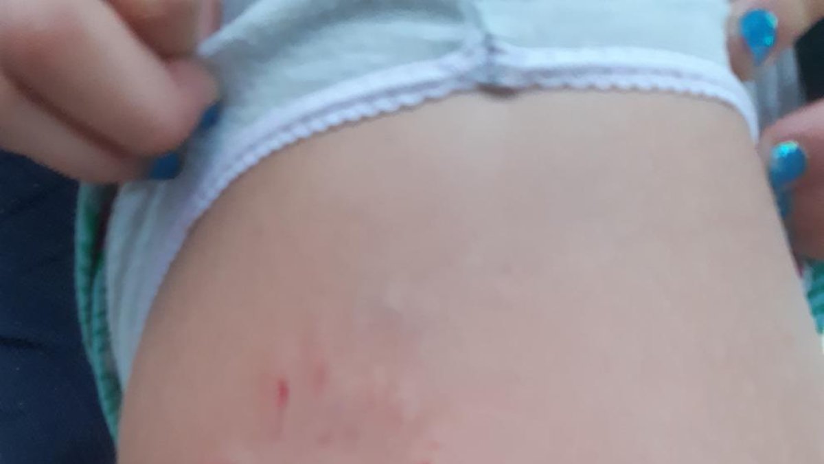 Imatge de les ferides que van causar els gossos a la menor de cinc anys.