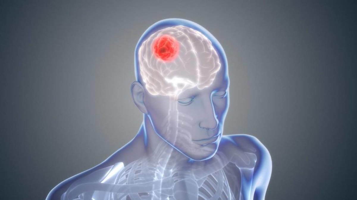 El fármaco se ha demostrado eficaz contra el tumor cerebral más común, el glioblastoma.