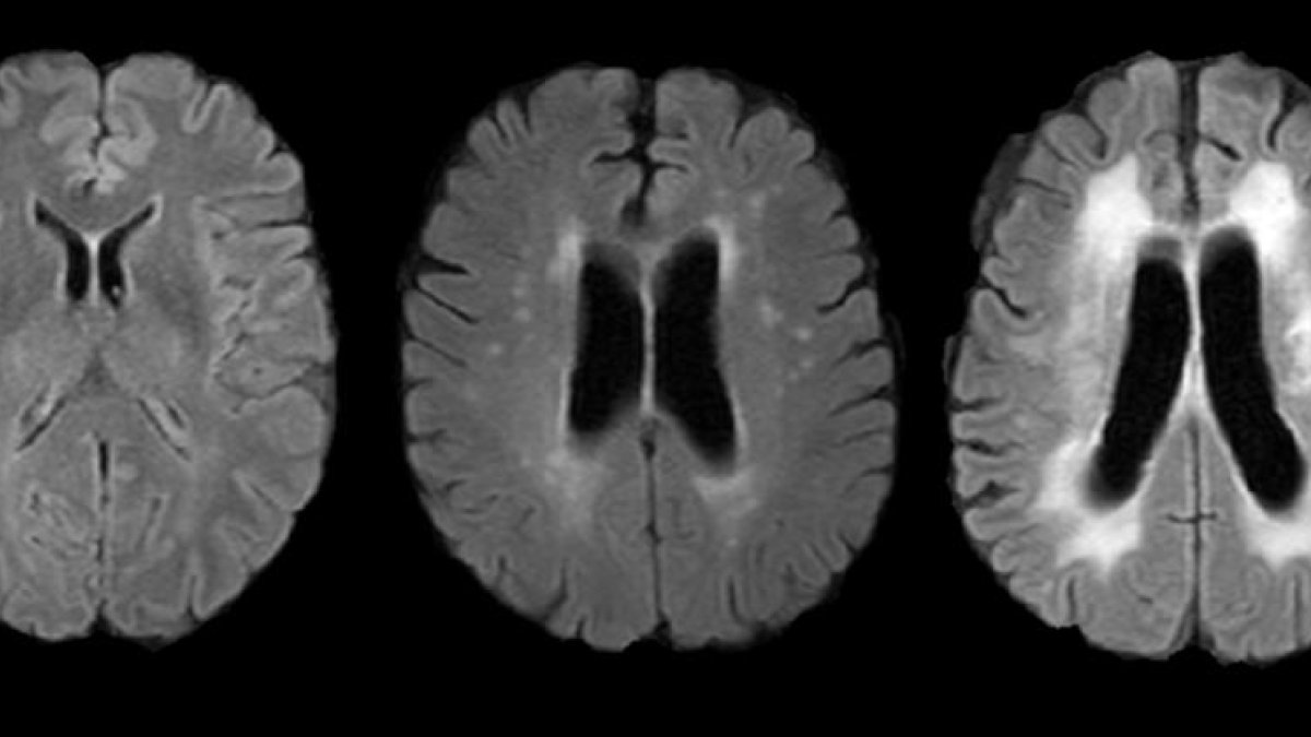 Imatge d'una ressonància del cervell.