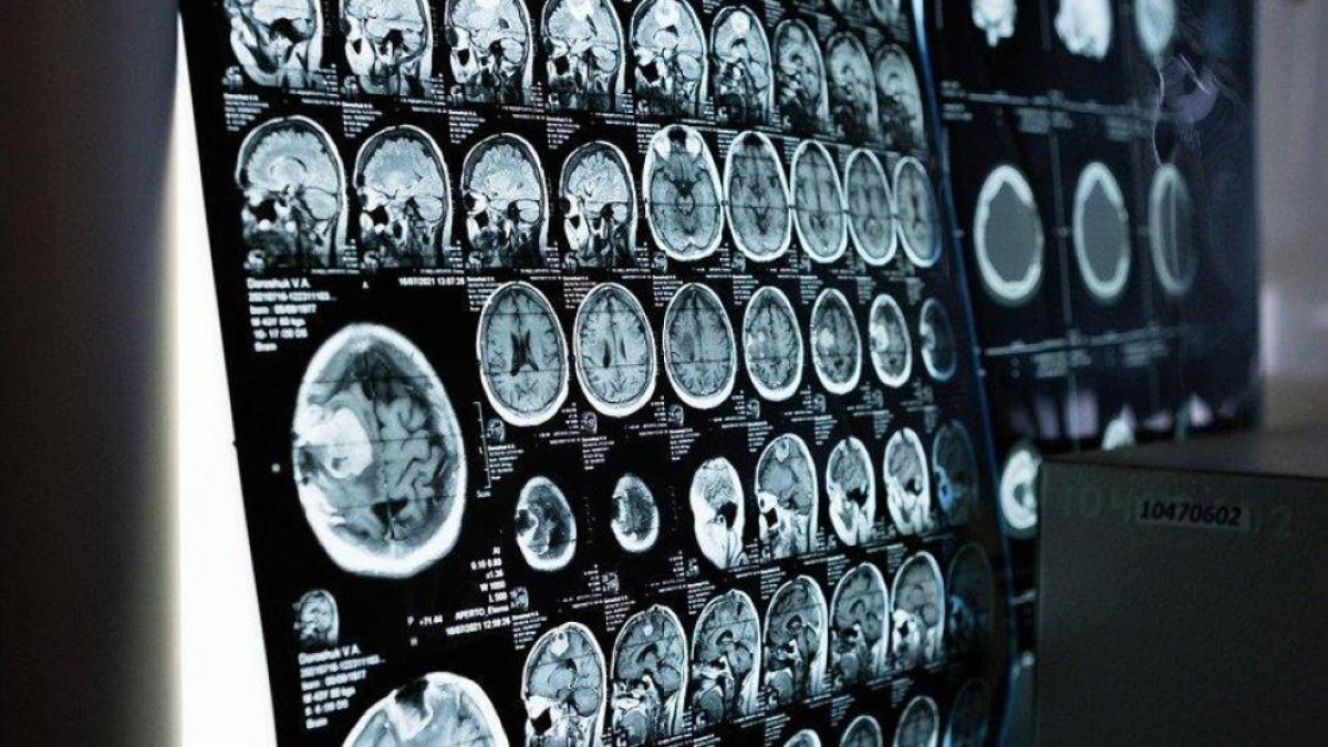 Imagen de la resonancia magnética de un cerebro.