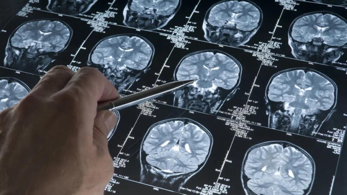 Un neurólogo analiza imágenes del cerebro.