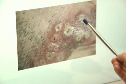 Una professional sanitària assenyalant un cas d'infecció de verola del mico.