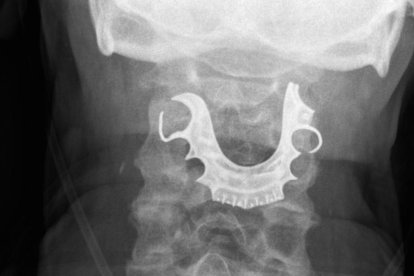 Radiografia frontal de la gola del pacient.