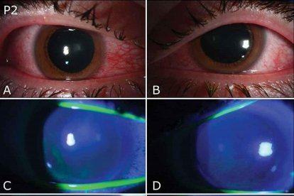 Imatge dels ulls d'un pacient que pateix fotoqueratitis a causa de l'exposició a un llum germicida.