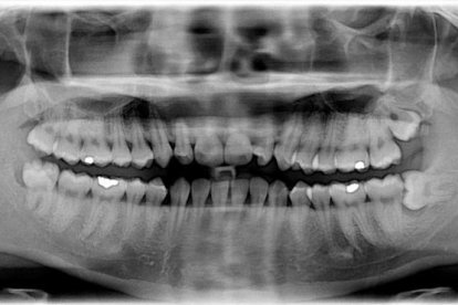 Radiografia on es veuen els queixals del judici.