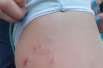 Imagen de las heridas que causaron los perros a la menor de cinco años.