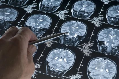 Un neuròleg analitza imatges del cervell.