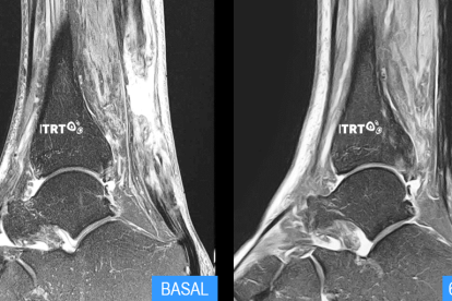 Imagen de la evolución de un tendón durante el tratamiento.