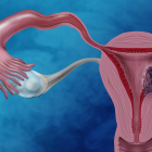 El cáncer de endometrio es uno de los más comunes.