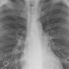 Radiografia d'uns pulmons.