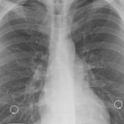 Radiografia dels pulmons.
